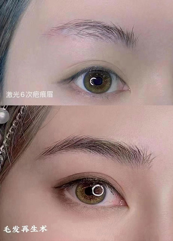 毛发再生术